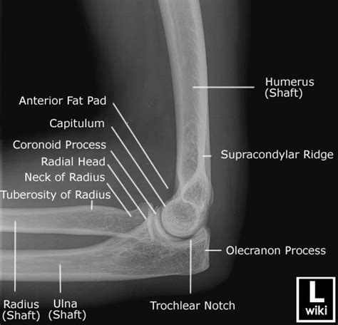 Radiographic Anatomy Elbow Lateral Radiology Schools Radiology Radiology Student