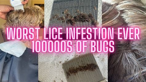 1 Yr Lice Infestation L Worst Lice Infestation Ever 😱 L 2 12 Hr Head