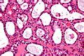 Hyaline Globules Libre Pathology