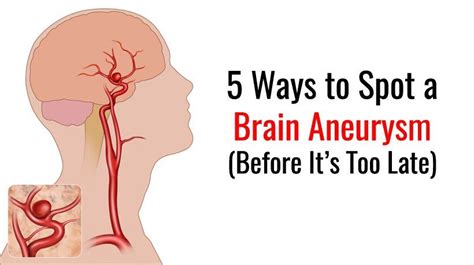 5 Ways To Spot A Brain Aneurysm Brain Aneurysm Aneurysm Brain Surgery