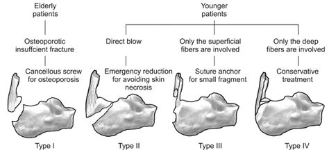 Avulsion Fracture Of The Calcaneal Tuberosity Classification And Its