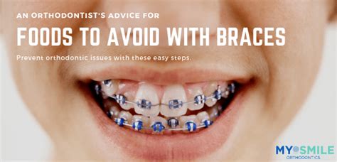 If you are particularly sore, you might wait until they are fully ripe and very soft before eating one. Foods to Avoid with Braces | My Smile Orthodontics New ...