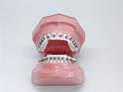 Artificial Model Of Human Jaw With Wire Colorful Braces Attached Stock