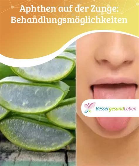 We did not find results for: Aphthen auf der Zunge und ihre Behandlung | Besser gesund ...