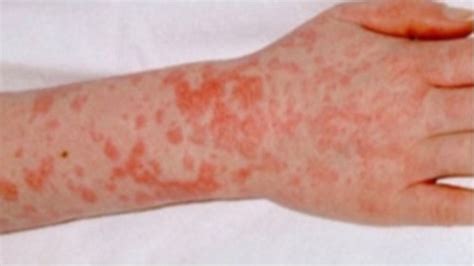 Warning To Parents After Massive Rise In Scarlet Fever Cases Itv News
