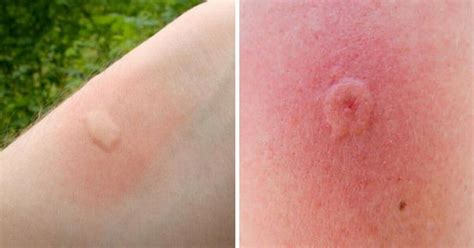 10 Insect Bitesstings That You Should Learn To Recognize This Summer