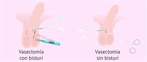 Vasectomy is a very effective contraception method with a failure rate of less than. Vasectomía | Tenemos todo lo que debes saber sobre