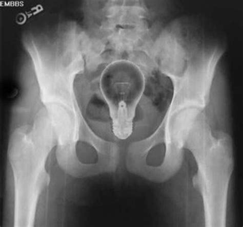 Most Shocking X Ray Photos Hubpages