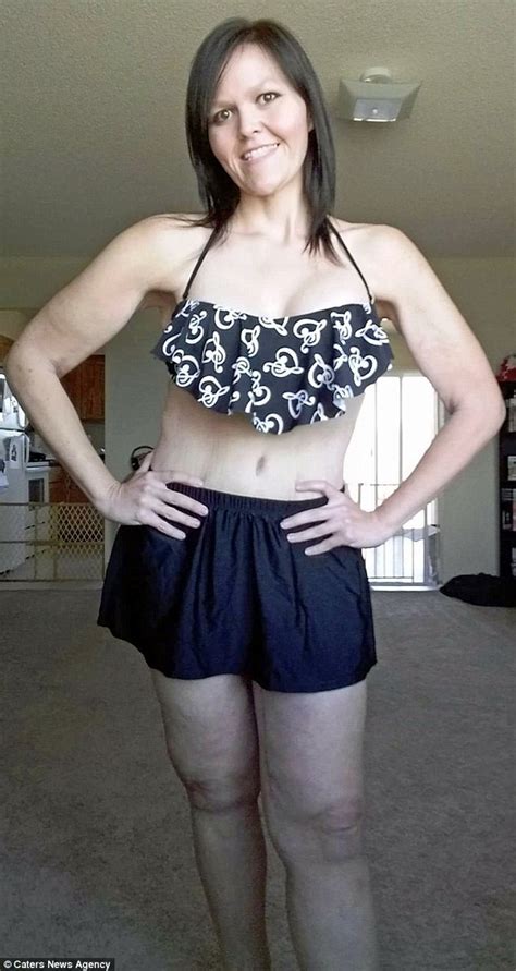 Mcdonalds Addict Tanya Benedict Has 30lbs Of Saggy Skin Removed In
