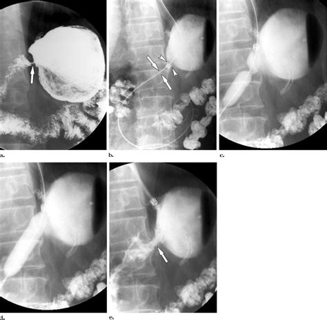 Gastric Outlet Obstruction Caused By Benign Anastomotic Stricture