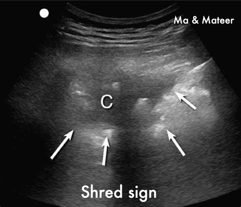 An Expanding Lung Mass And Assessment For Consolidations On Lung