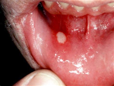 When the sores appear on the tongue, they are often on the underside. Canker Sores | TheraBreath