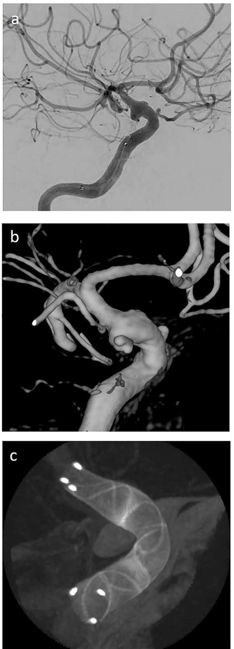 A Lateral Angiogram Of Left Carotid Artery Showing An Ica Aneurysm