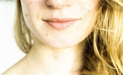 Sun Spots On Skin Face