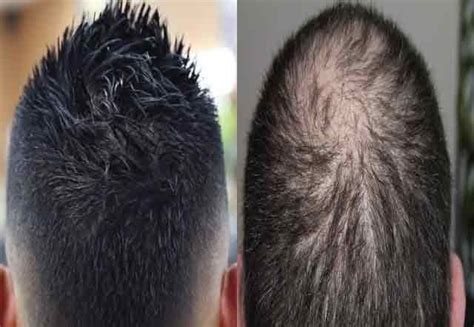 How To Regrow Hair On Bald Head 10 Powerful Natural Solutions