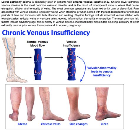 chronic venous insufficiency - cardio | Venous insufficiency, Medical ...