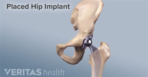 Advantages And Disadvantages Of Anterior Hip Replacement In 2021 Hip