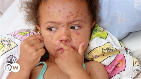 Why Is Measles So Deadly Dw 03272019