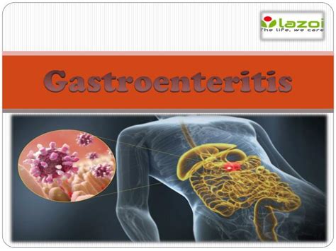 Overview of gastroenteritis, by thomas g. PPT - gastroenteritis PowerPoint Presentation, free download - ID:7433876