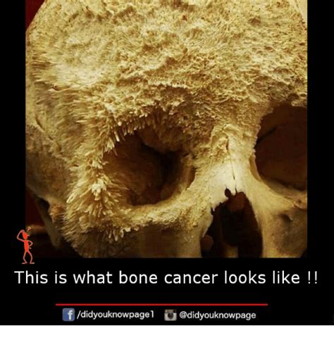 But some types of cancer are particularly likely to spread to bone, including breast cancer and prostate cancer. This Is What Bone Cancer Looks Like !! Didyouknowpagel ...