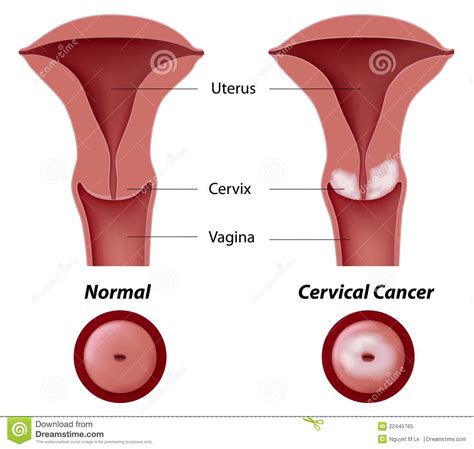 The first identifiable symptoms of cervical cancer are likely to include: Cervical Cancer Royalty Free Stock Photo - Image: 22445765