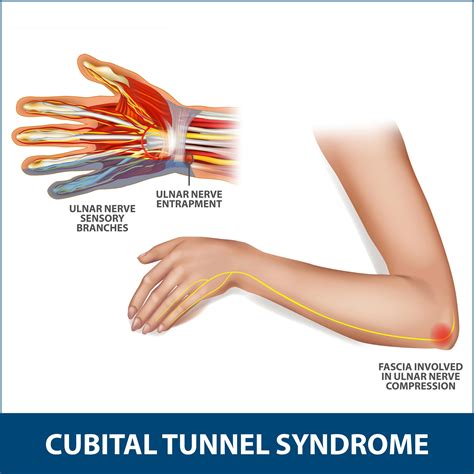 Ppt Cubital Tunnel Syndrome Causes Symptoms Diagnosis