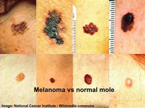 Black Spots On Skin Causes Treatments Pictures And More
