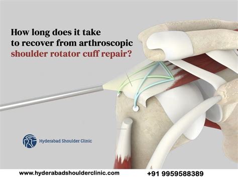 How Long Does It Take To Recover From Arthroscopic Shoulder Rotator