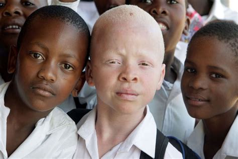 PBB Kecam Lonjakan Penyerangan Terhadap Warga Albino Satu Harapan