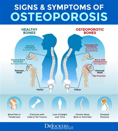 Osteoporosis Symptoms Causes And Natural Support Strategies