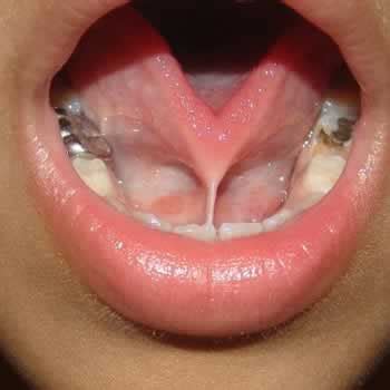 Tongue Tie Diagnosis And Treatment O Connor Dental Health