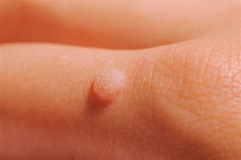 Warts And Molluscum Contagiosum — Hunter Dermatology