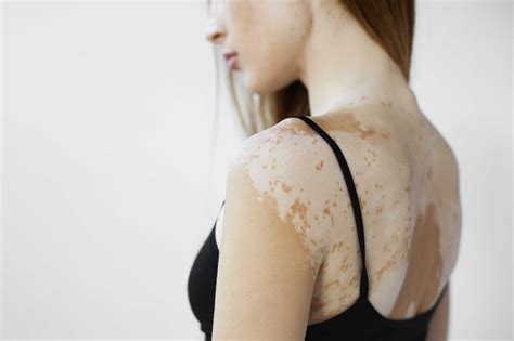 Researchers Making Progress On Causes Of Vitiligo