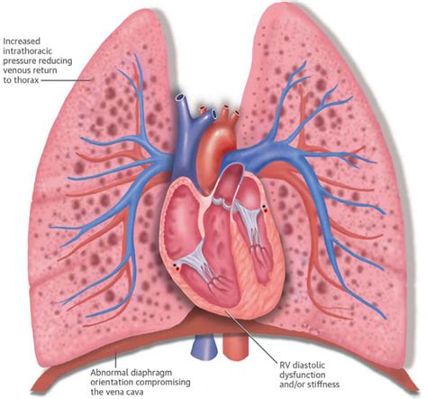 Cor Pulmonale Causes Symptoms Diagnosis Prognosis And Treatment