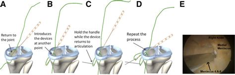 The Meniscus A II Device Is Returned To The Joint A And The Device Download Scientific