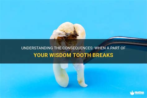 Understanding The Consequences When A Part Of Your Wisdom Tooth Breaks