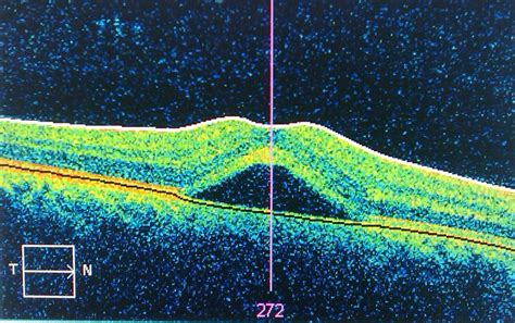 ~ how was central cee discovered? Central serous retinopathy - Wikipedia