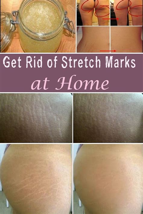 Stretch Marks Are Tricky Because No Matter How Many Treatments You Try They Wont Disappear