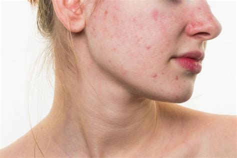 Check spelling or type a new query. Top Ten Tips to Get Rid of Post Acne Red Spots - Womens ...