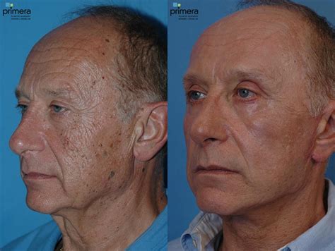 Laser Skin Resurfacing Dot Co2 Before And After Pictures Case 24