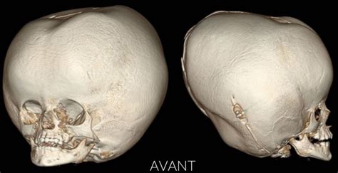 Surgeons Reconstruct Girls Skull After Her Head Swells To Dangerous