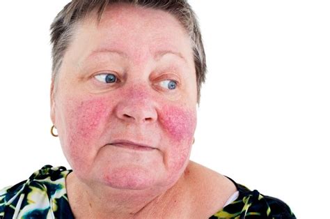 Red Skin Syndrome Rosacea And Demodex Understanding The Connection