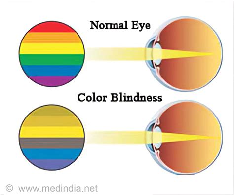 Diagram Color Blind Eye Diagram Mydiagramonline