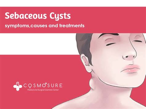 Sebaceous Cysts Symptoms Causes And Treatments Artofit