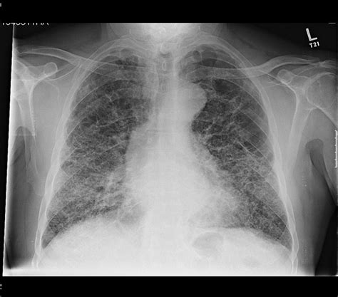 Combined Pulmonary Fibrosis And Emphysema Respiratory Care