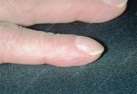 White with a dark line at the tip (terry's nails) a curved horizontal line near the tip of a white nail can signal liver disease, congestive heart failure or diabetes, as well as hyperthyroidism or malnutrition. Clubbing (acropachy) of fingers from renal failure - Stock Image - M130/0465 - Science Photo Library
