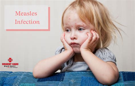 Measles Infection Symptoms Causes Treatment And Prevention