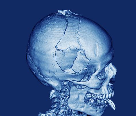 Fractured Skull Photograph By Zephyrscience Photo Library Pixels