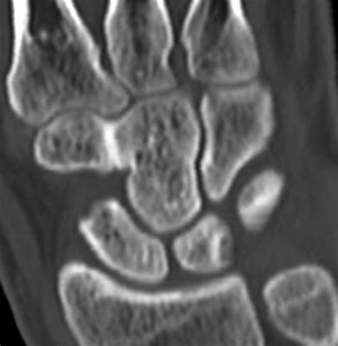 Carpal Coalition Radiology Reference Article Radiopaedia Org Radiology Medical Most Common