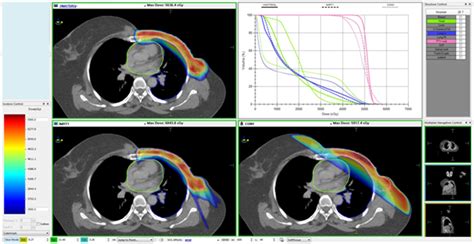 Modulated Radiotherapy For Breast Cancer Locoregional Outcomes